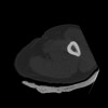 SPORK, NICO - 22.03.1976 - 02.08.2022 - CT obere Extremität - 18:02:23